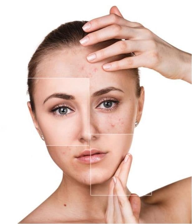 Peeling Químico Avanzado